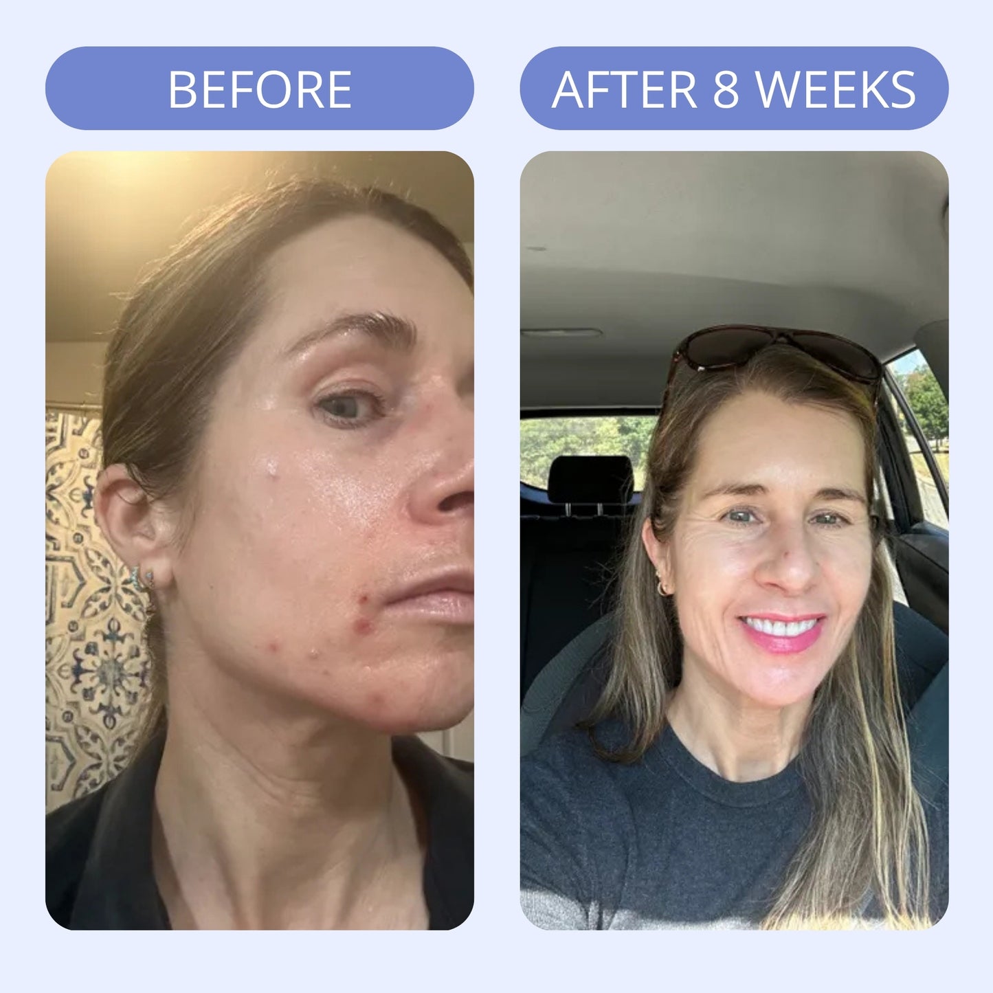 Hormonal Acne Supplement