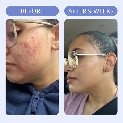 Hormonal Acne Supplement