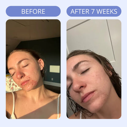 Hormonal Acne Supplement